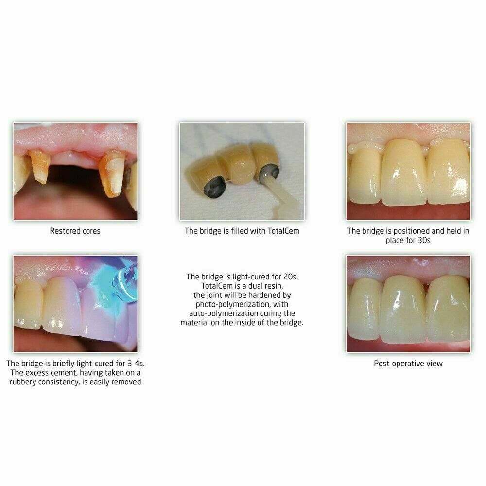 Dengen Self Etch Self Adhesive Resin Gic Cement Permanent Cement Best