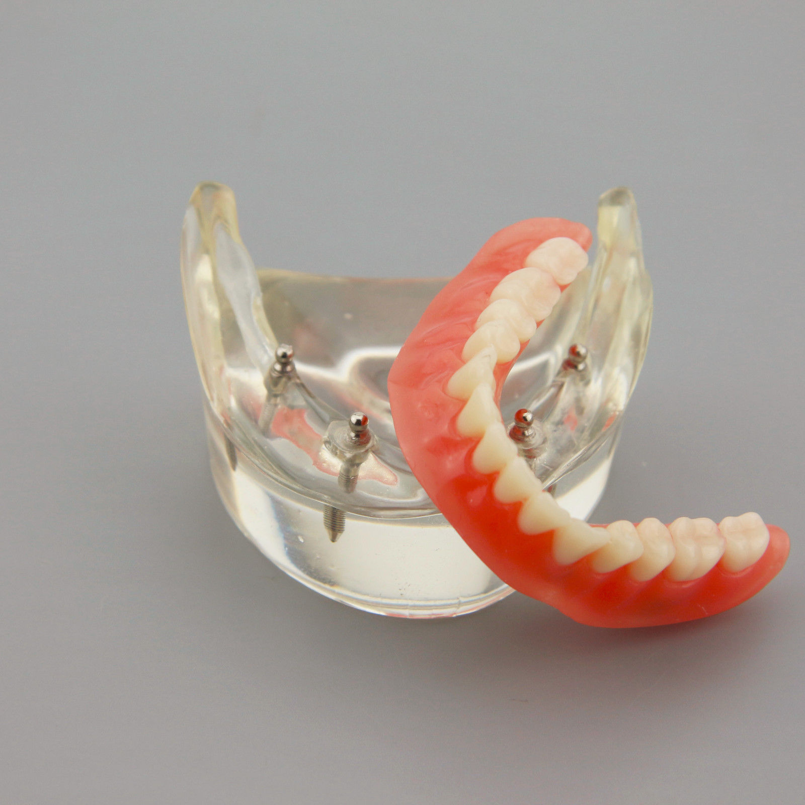 Dental Implants Restoration Model Overdenture Inferior With Demo Teaching Study