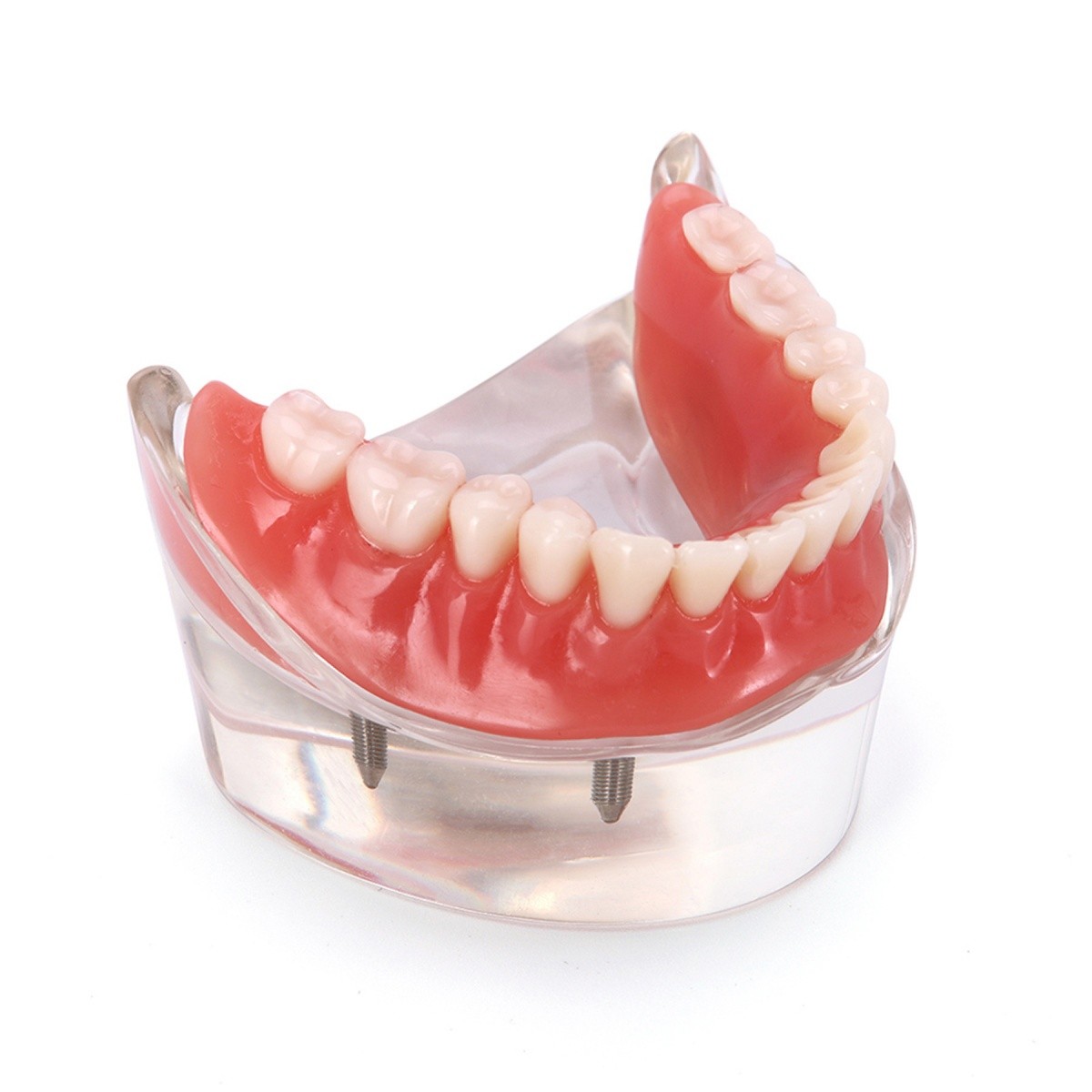Dental Implant Teeth Model 4 Implants Upper/Lower Overdenture Restoration Model