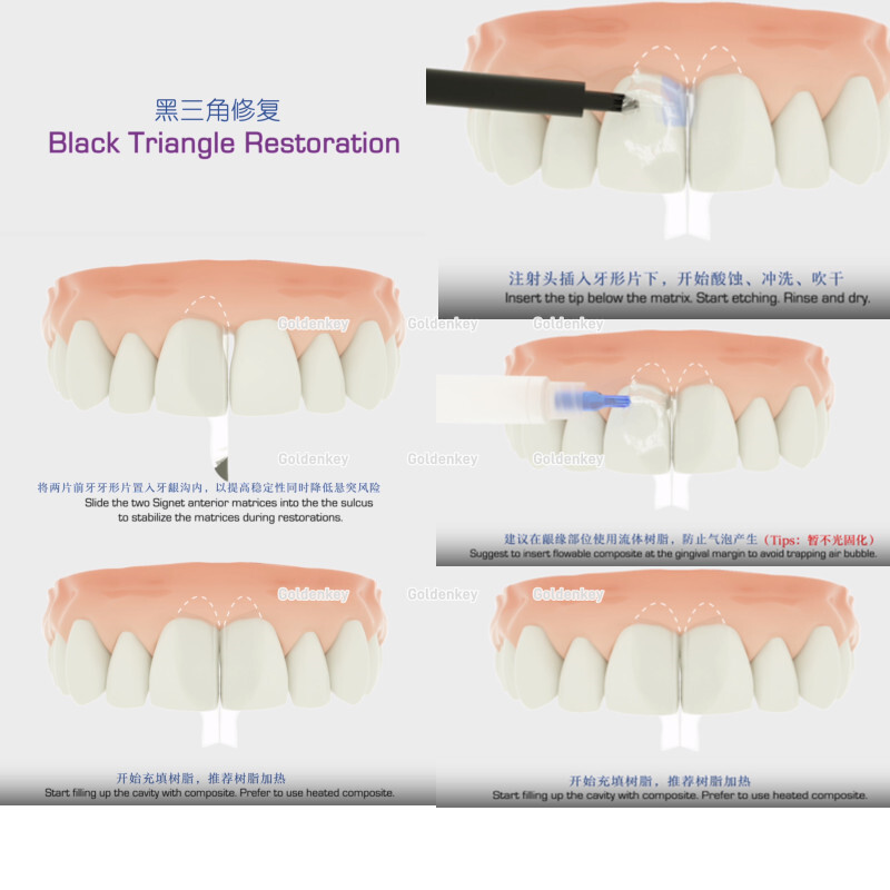 Clear Matrix Dental BT Matrices Black Triangle Wedges Diastema Fits BioClear