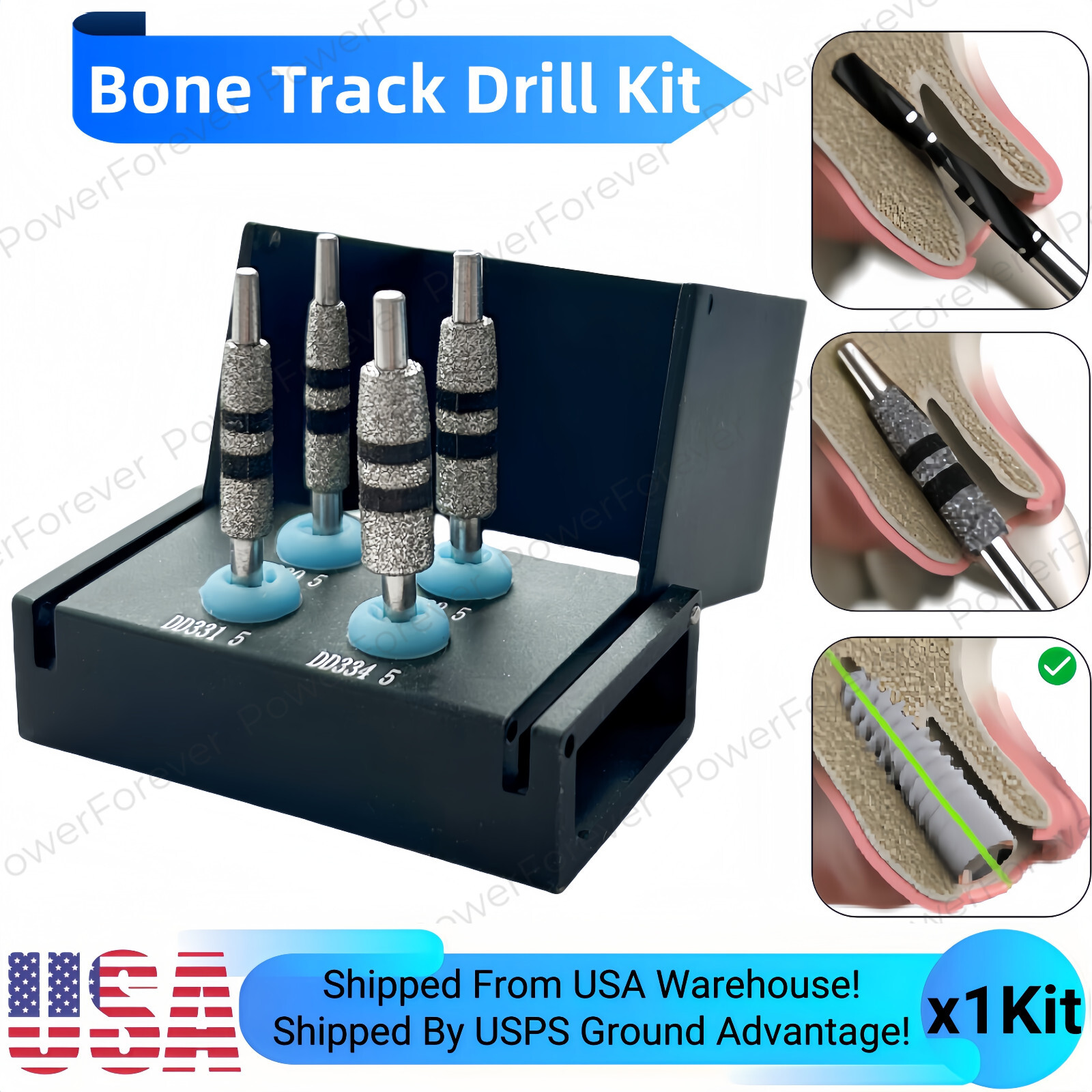 1Kit Dental Bone Track Drill Kit JD Guided Neck Correction Drills Diamond Cut