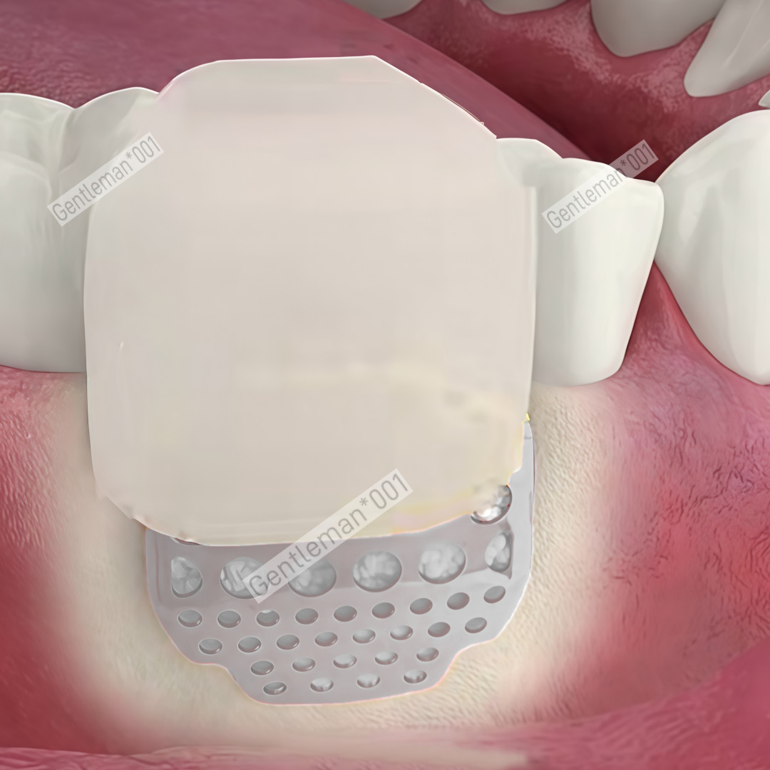 GBR Bone Incremental Titanium Mesh Membrane Implant Dental Regeneration Plates