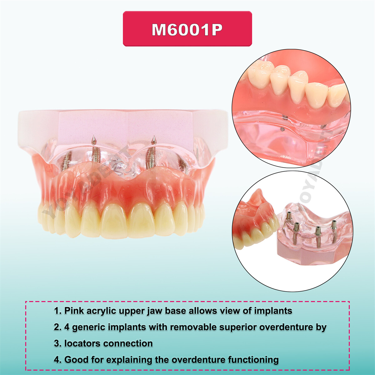 US Dental Typodont Teeth Model Ortho Overdenture Implant Practice Teaching Demo