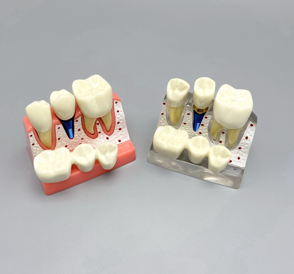 Dental Teaching Model Removable Communication Models Crown Bridge 4 Times Impant