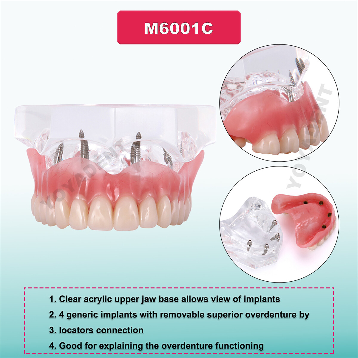 Dental Teeth Model Upper Lower Jaw 4 Overdenture Practice Implant Typodont Demo