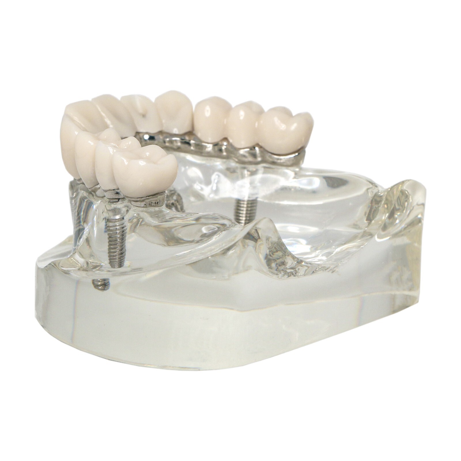 All-on-4 Overdenture Clear Model Dental Implant Upper Jaw Restoration 4 Screws