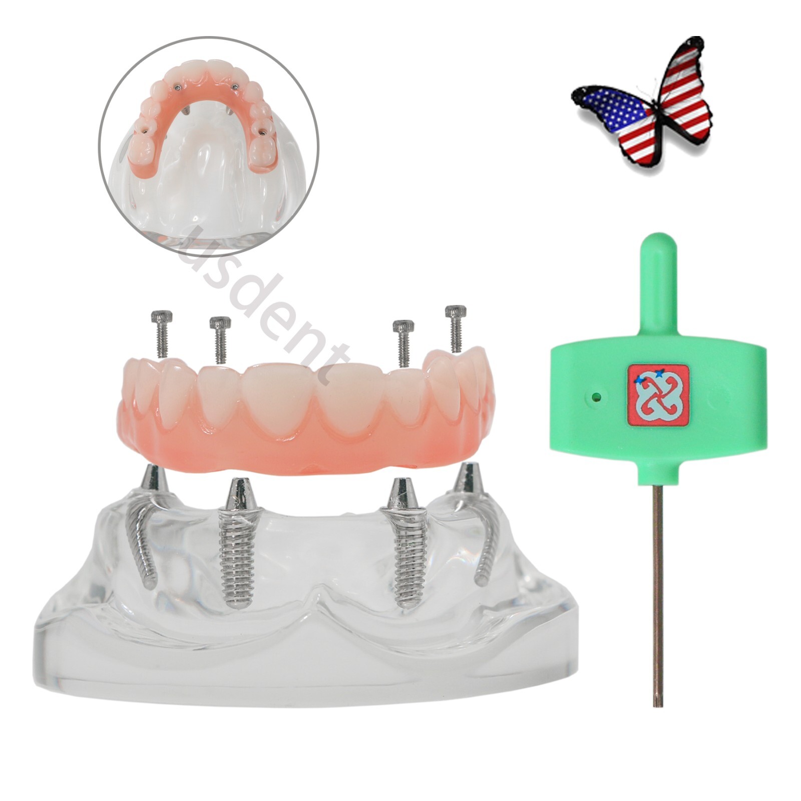All on 4 Dental Implant Model Overdenture Upper Jaw 4 Implant Clear Detachable