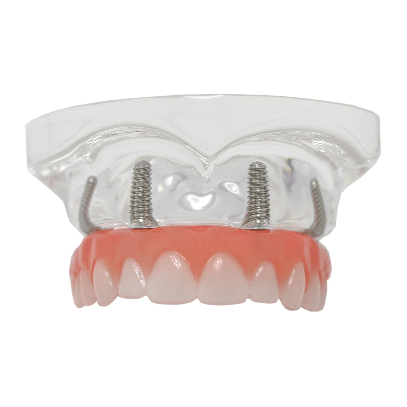 US Dental Implant Model All-on-4 All-on-6 Overdenture U/L Jaw 4/6 Screws Clear