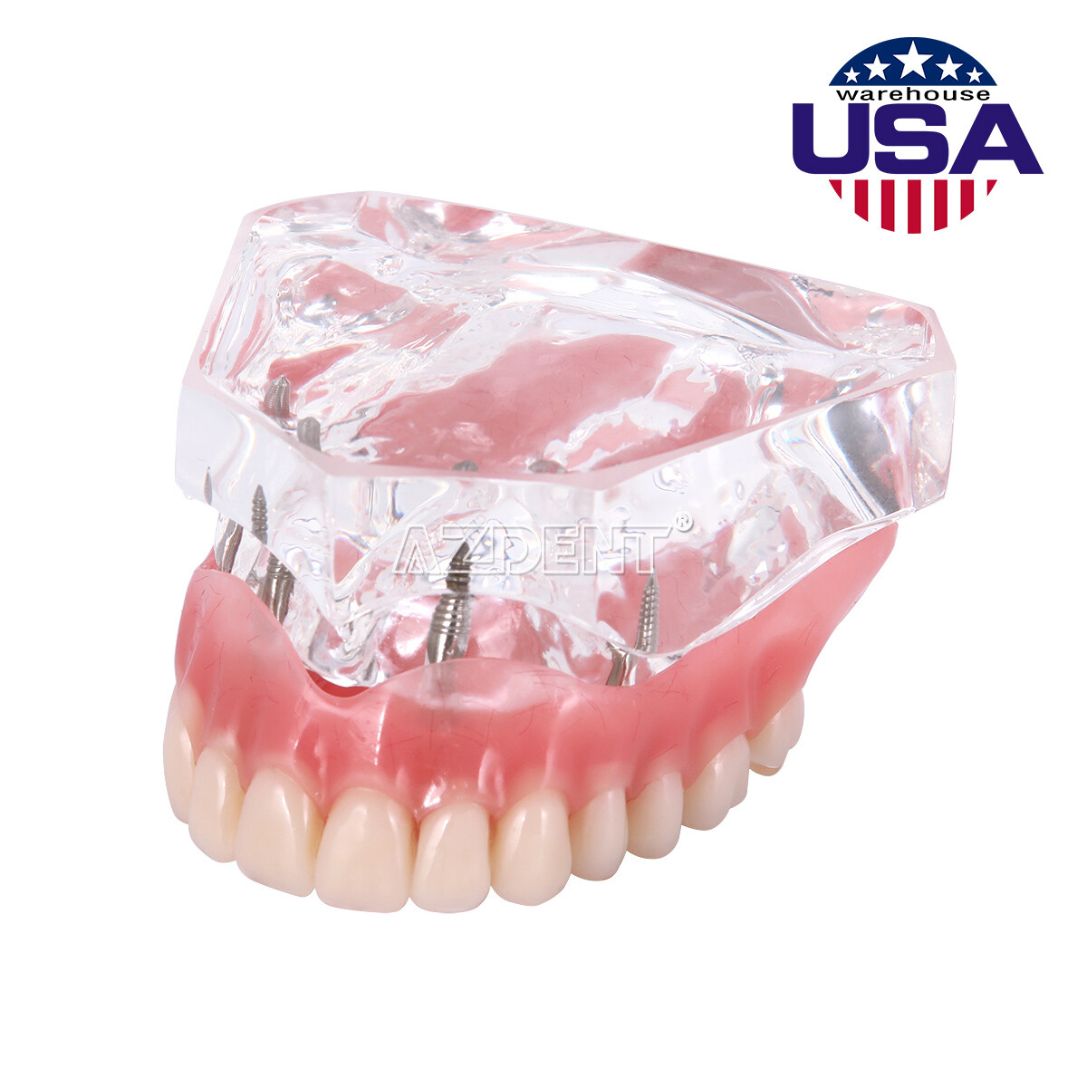 Dental Implant Teeth Model Demo Overdenture Restoration With 2 / 4 Implants