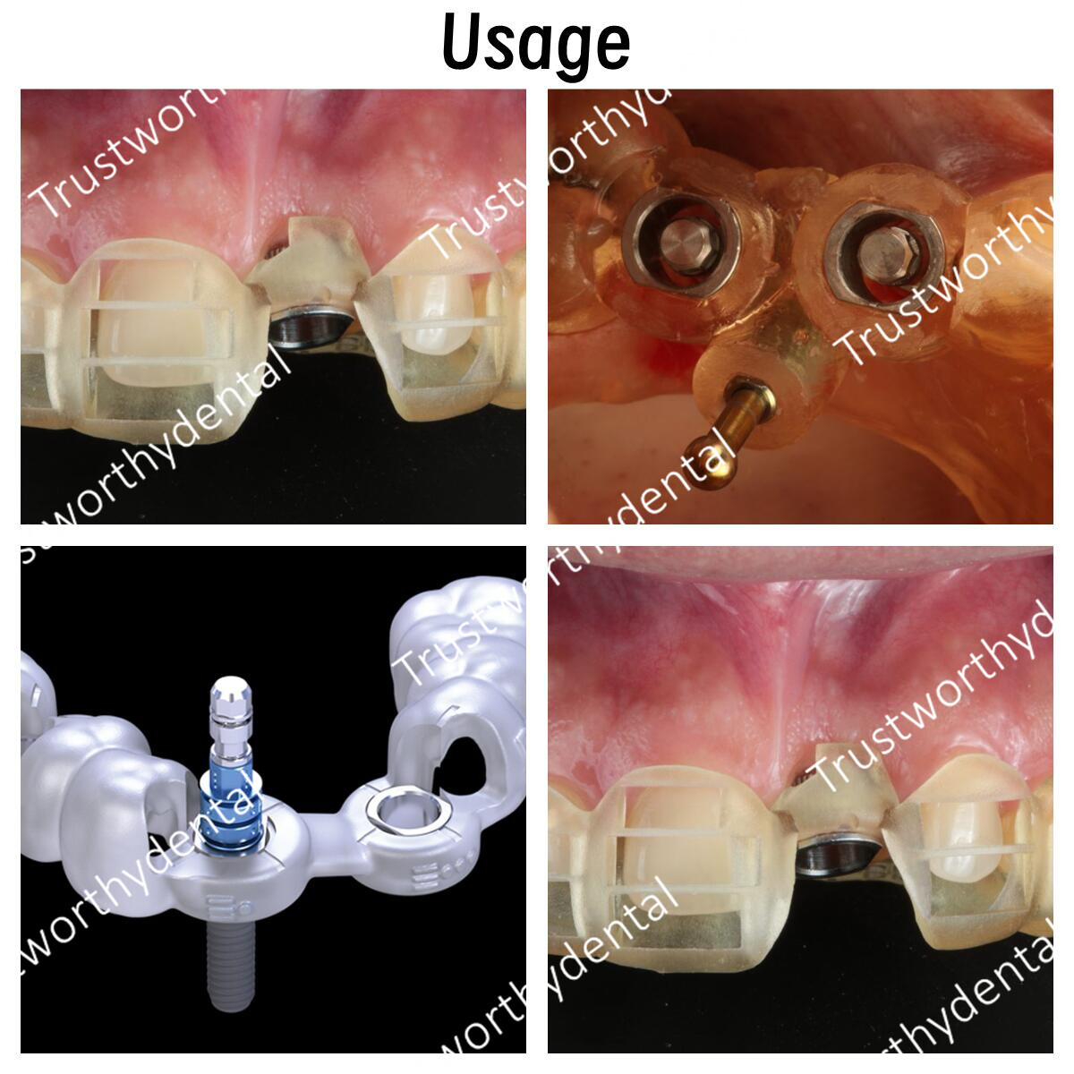 10Pcs Dental ITI Guided Sleeve ∅5.0/2.2 T-Sleeves Digital Guidance Straumann US