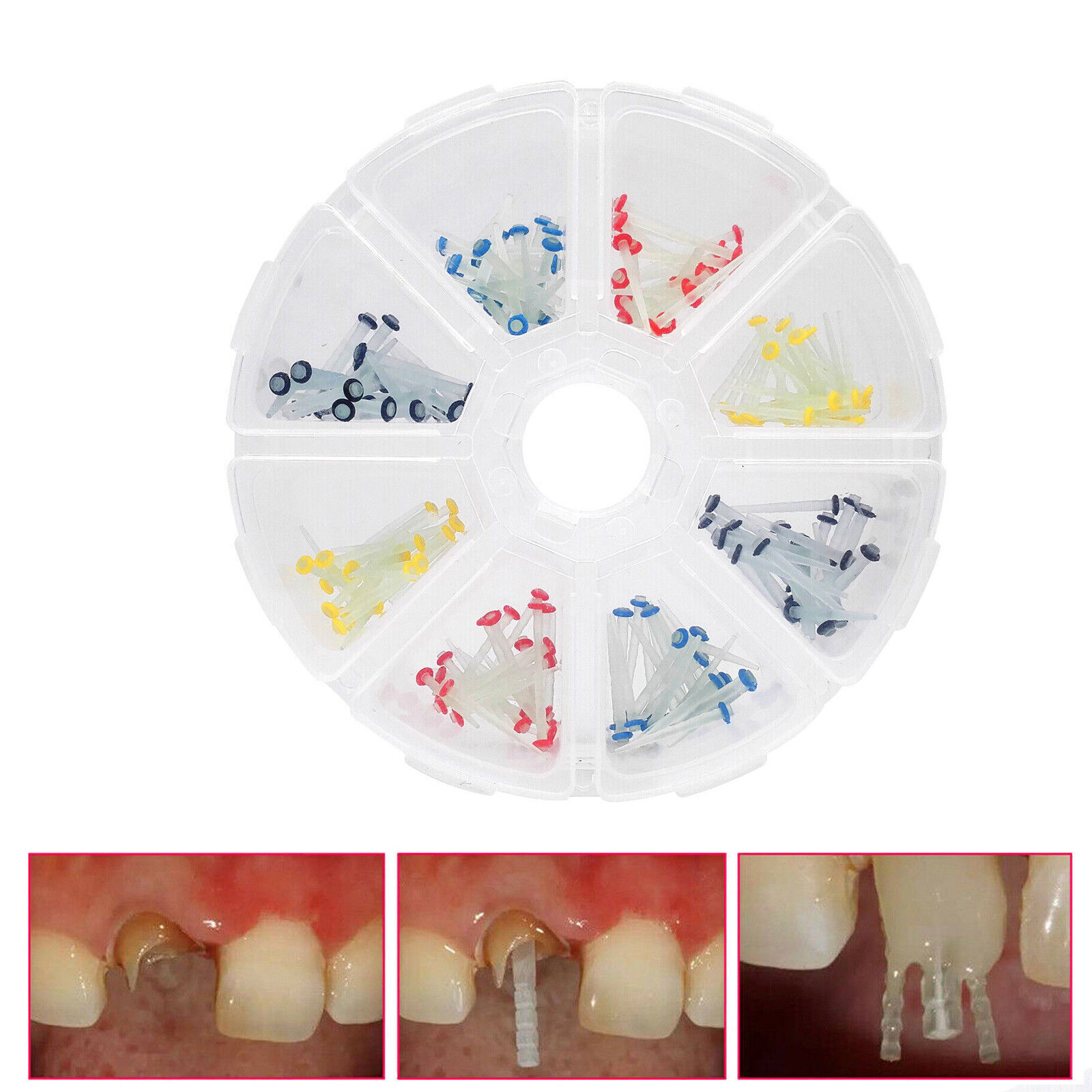 USA Dental Fiber Post Glass Quartz Teeth Restorative 1.0/1.2/1.4/1.6/1.8mm