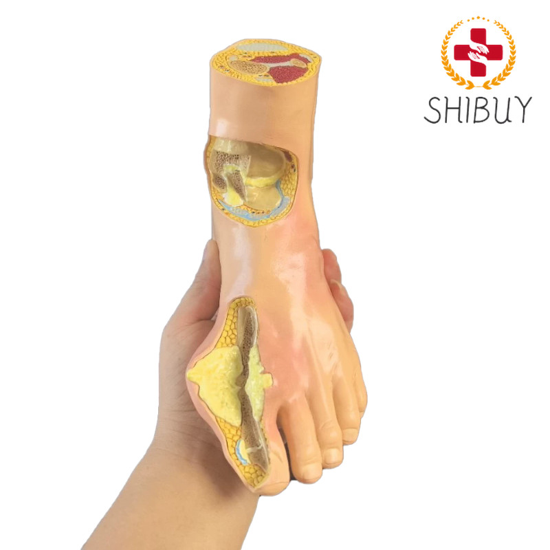 Diabetes Target Organ Model Pain Wind Stone Foot Complication Model