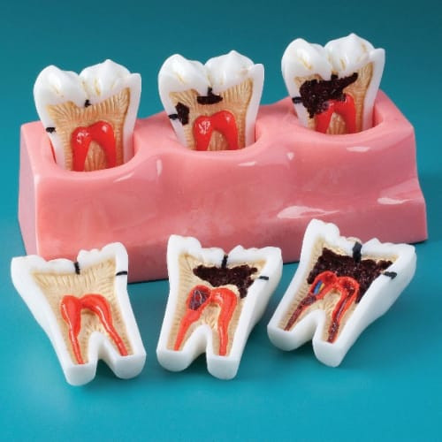 MDO DI Caries Progression Model – Hand-crafted Detail