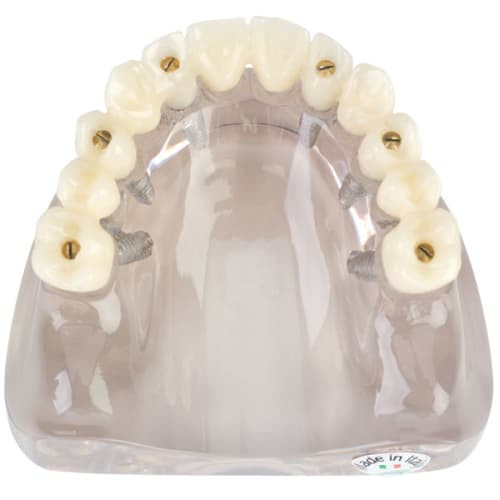 MDO DI Screw-Retained Full Arch Implant Model – Six Fixed Implants