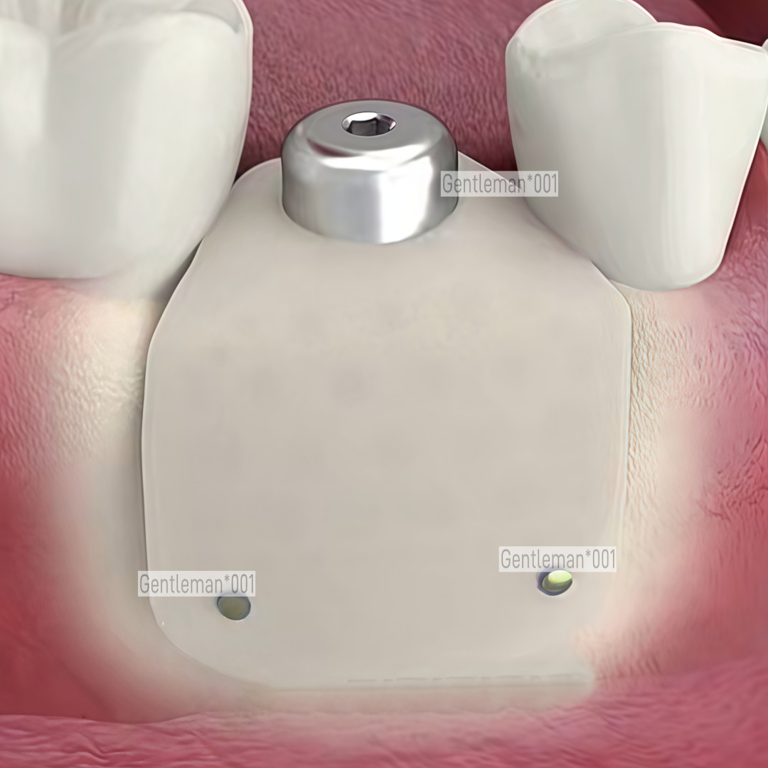 GBR Bone Incremental Titanium Mesh Membrane Implant Dental Regeneration Plates